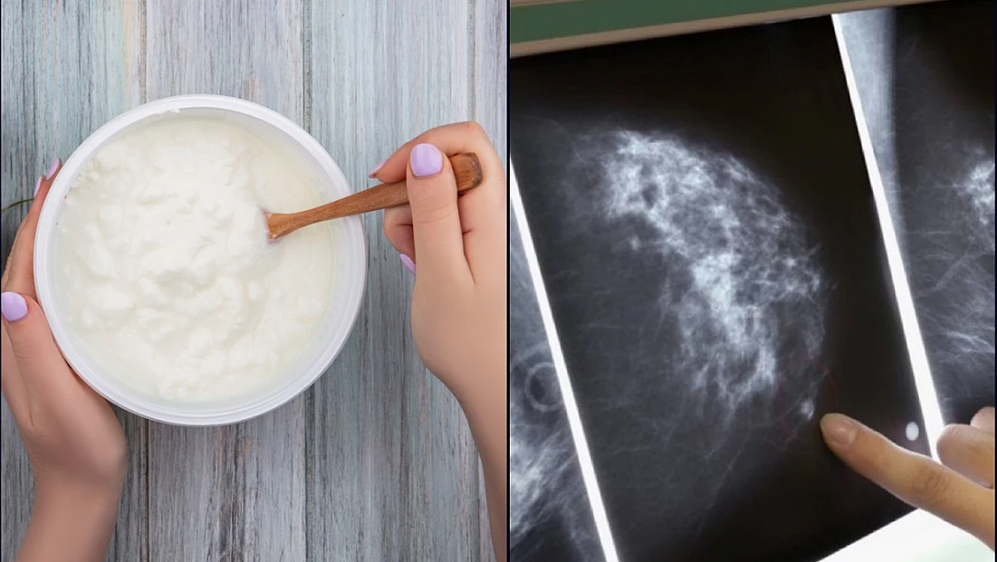 Meme mikroflorası ve kanser riski: Bakteriyel iltihaplanmaya dayalı yeni bir hipotez