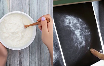 Meme mikroflorası ve kanser riski: Bakteriyel iltihaplanmaya dayalı yeni bir hipotez