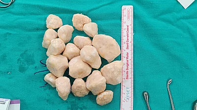 Malatya'da Eş Zamanlı Tümör Temizliği ve Diz Protezi Ameliyatı Başarıyla Gerçekleşti