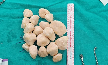 Malatya'da Eş Zamanlı Tümör Temizliği ve Diz Protezi Ameliyatı Başarıyla Gerçekleşti