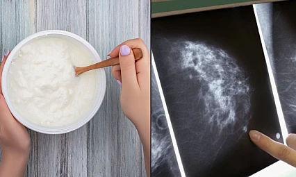 Meme mikroflorası ve kanser riski: Bakteriyel iltihaplanmaya dayalı yeni bir hipotez