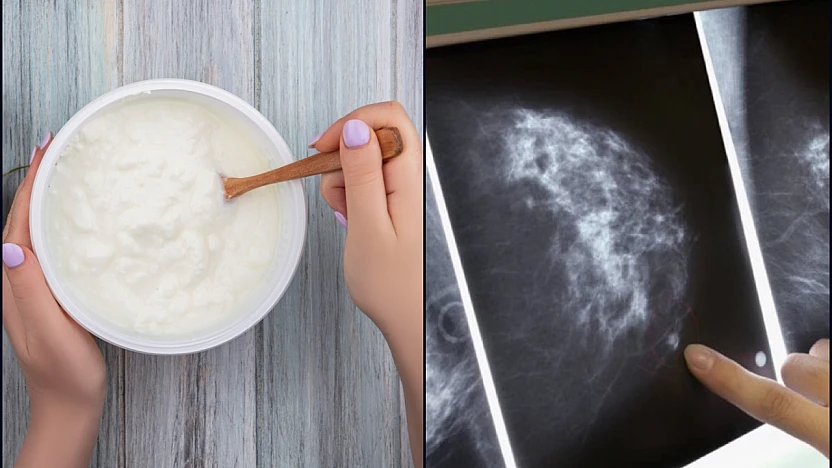 Meme mikroflorası ve kanser riski: Bakteriyel iltihaplanmaya dayalı yeni bir hipotez